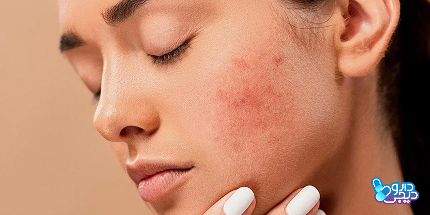 چگونه می توانیم آکنه هورمونی را از آکنه باکتریایی تشخیص دهیم؟