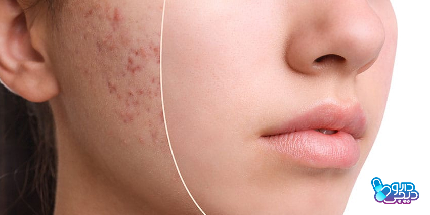 جوشهای هورمونی چه شکلی دارند؟